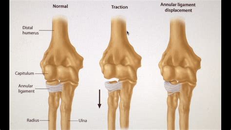 Clinical Case 112: Pulled Elbow Tricks - Broome Docs