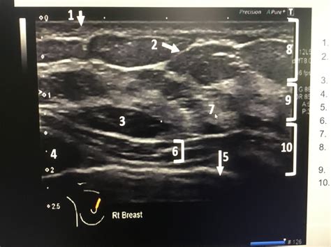 Breast Tissue Anatomy On US Diagram Quizlet