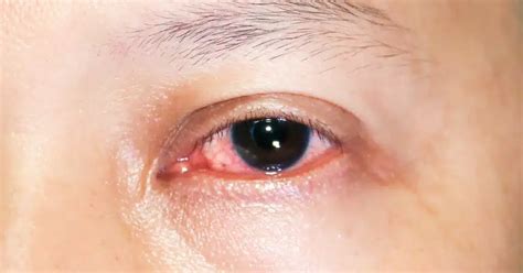 Uveitis Vs Conjunctivitis Understanding The Key Differences