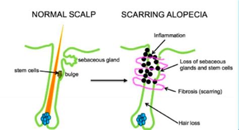 What is scarring alopecia? — Donovan Hair Clinic