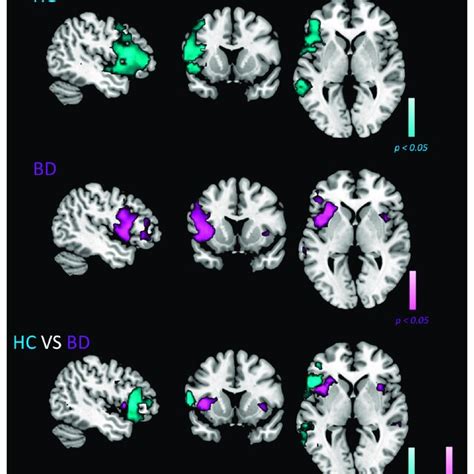 Shows The Random Effect Group Level T Maps For Ln Of Hc Top Row And