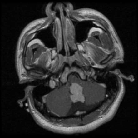 Choroid Plexus Papilloma Image Radiopaedia Org