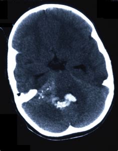 Ependymoma Brain Tumor