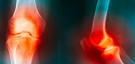 Physical Solutions | Total Knee Replacement - Physical Solutions