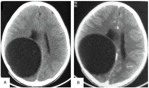 Diagnostics Free Full Text Hydatid Disease A Radiological