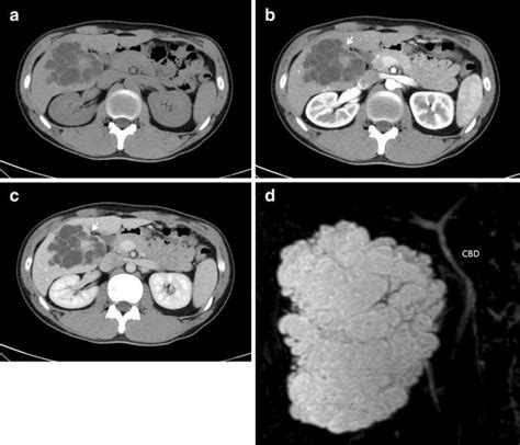 A Variant Of Multicystic Biliary Hamartoma Presenting As An