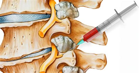 Medial Branch Block | TriMed Spine & Joint