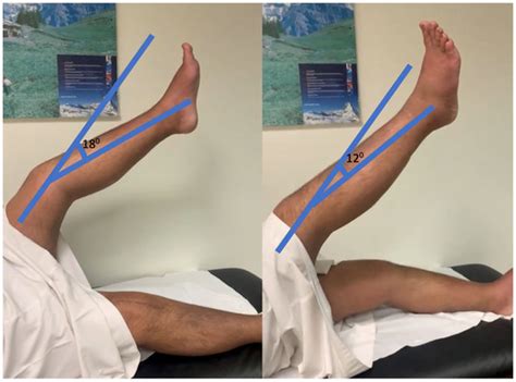 Healthcare Free Full Text Management Of Bilateral Quadriceps Tendon