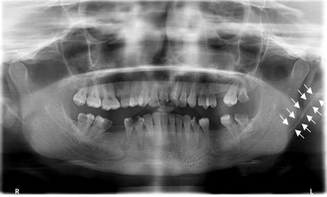 Calcified Stylohyoid Ligament Pano