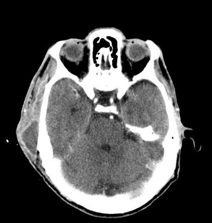 Otomastoiditis with retroauricular abscess | Radiology Case | Radiopaedia.org