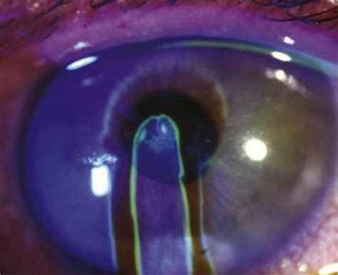 Trauma The Wills Eye Manual