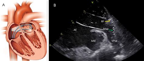 Scielo Brasil Fibrilação Atrial Parte 2 Ablação Por Cateter