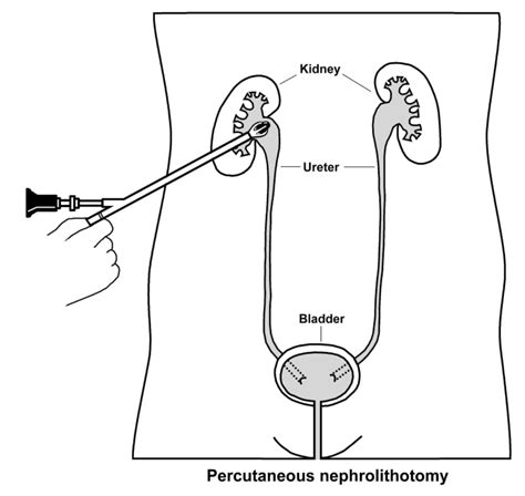 Nephrolithotomy