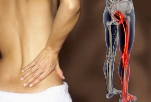 Sciatica Symptoms Including Back Pain and Leg Cramps | New Jersey Spine Specialists