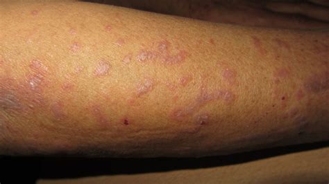 Dermoscopic Signs Of Lichen Planus Bmj Case Reports