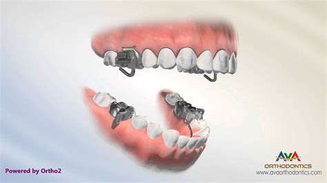 Overjet Aka Overbite Treatment By Mara Orthodontic Device Youtube