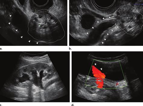 Paracervical Endometriosis With Ureteral Stenosis In A 35 Year Old