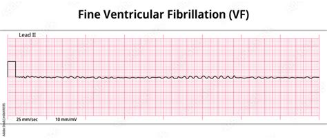 ECG Fine Ventricular Fibrillation - 8 Second ECG Paper - Electrocardiography Medical Vector ...