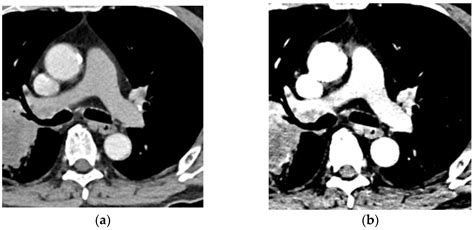 Diagnostics Free Full Text Advances For Pulmonary Functional Imaging Dual Energy Computed