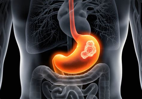 Gastric Cancer Overview Causes Symptoms Treatment Prevention Tips