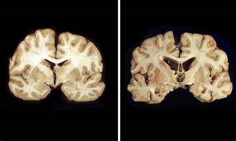 The Brain Starts Eating Itself When You Don't Get Enough Sleep ...