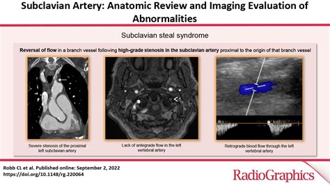 Subclavian Artery Anatomic Review And Imaging Evaluation Of Abnormalities Radiographics