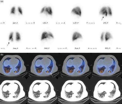 Diseases Of The Pulmonary System Radiology Key