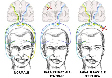 Cause Paralisi Facciale Riccardo Castellini Fisioterapista Milano