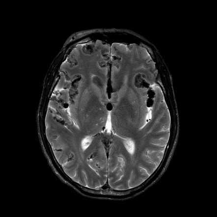 Pneumocephalus Image Radiopaedia Org