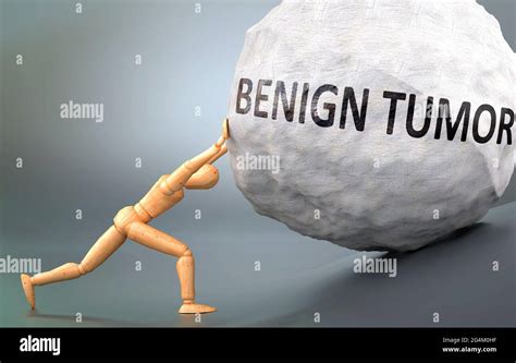 Benign tumor hi-res stock photography and images - Alamy