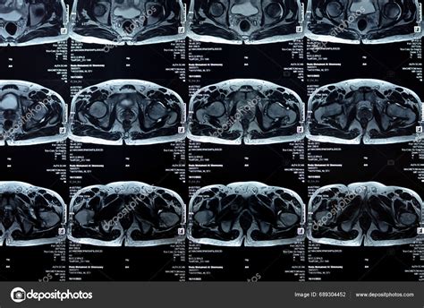 Cairo Egypt November Mri Hip Joint Showing Bilateral Femoral