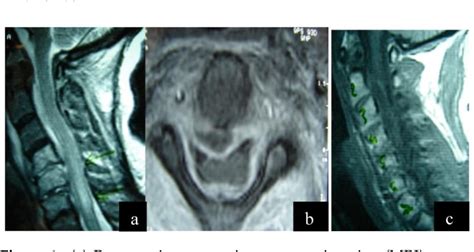 Figure 1 From Cervical Spinal Epidural Abscess Diagnosis Treatment