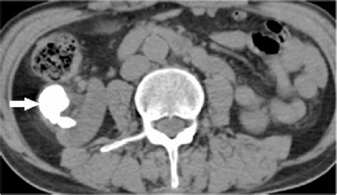 Axial Non Contrast Ct Section White Arrow Points To The Lateral Renal Download Scientific