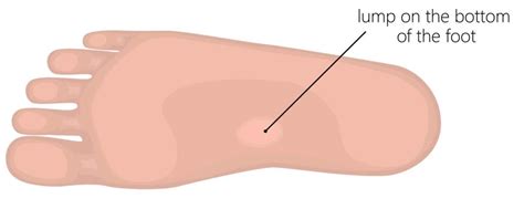 Tiny Hard Bump On Bottom Of Foot Hotsell Emergencydentistry