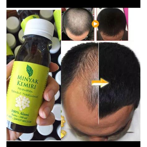 Jual Minyak Kemiri Original Penumbuh Rambut Penyubur Rambut Vitamin