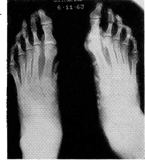 Figure From Calcinosis Cutis Old Dermatomyositis Semantic Scholar