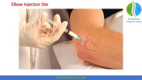 Elbow Injection Technique Orthofixar