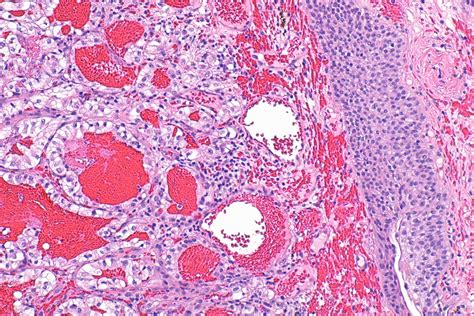 Renal Cell Carcinoma Histology