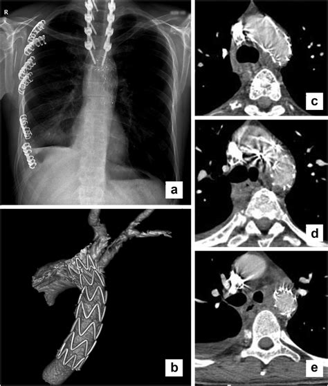 Post Operative Antero Posterior X Ray Image Shows The Aortic Stent