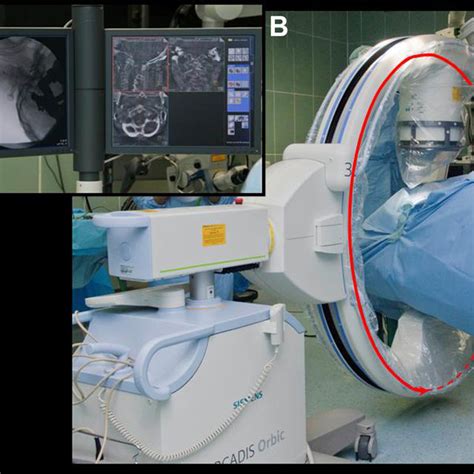 A And B C Arm Used For Intraoperative 3 D Imaging And Navigation