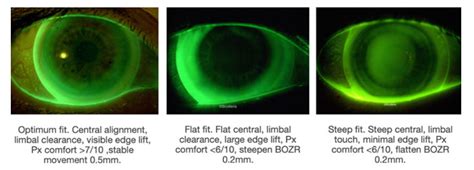 Corneoscleral Scotlens