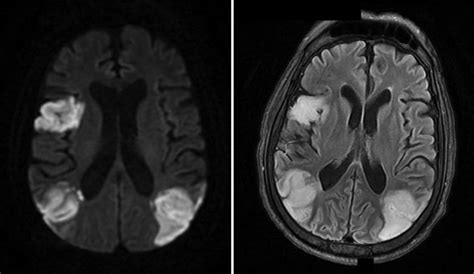 Ischemic strokes in a patient with COVID-19. MRI brain in a patient ...