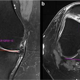 MRI scan to obtain trochlea angle measurements. (a) Trochlear ...