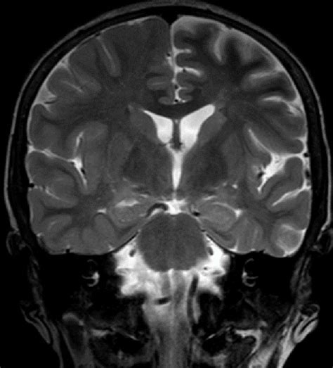 Coronal Section In The T Sequence Hyperintensity Of Cortical Signal