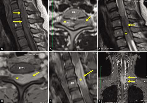 A Rare Case Of Intramedullary Cervical Spinal Cord Meningioma And