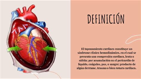 Diagrama De Taponamiento Cardiaco