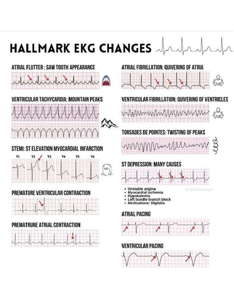 ECG Tracing - references - Medical Surgical Nursing - Studocu