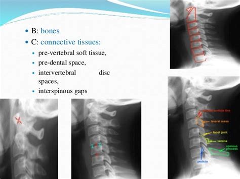 Evaluation And Management Of Cervical Spine Injury