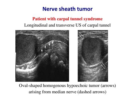 Ultrasound of carpal tunnel syndrome