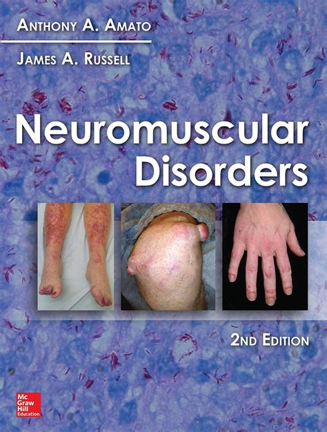 Neuromuscular Disorders Nd Edition Ebook By Anthony A Amato Epub